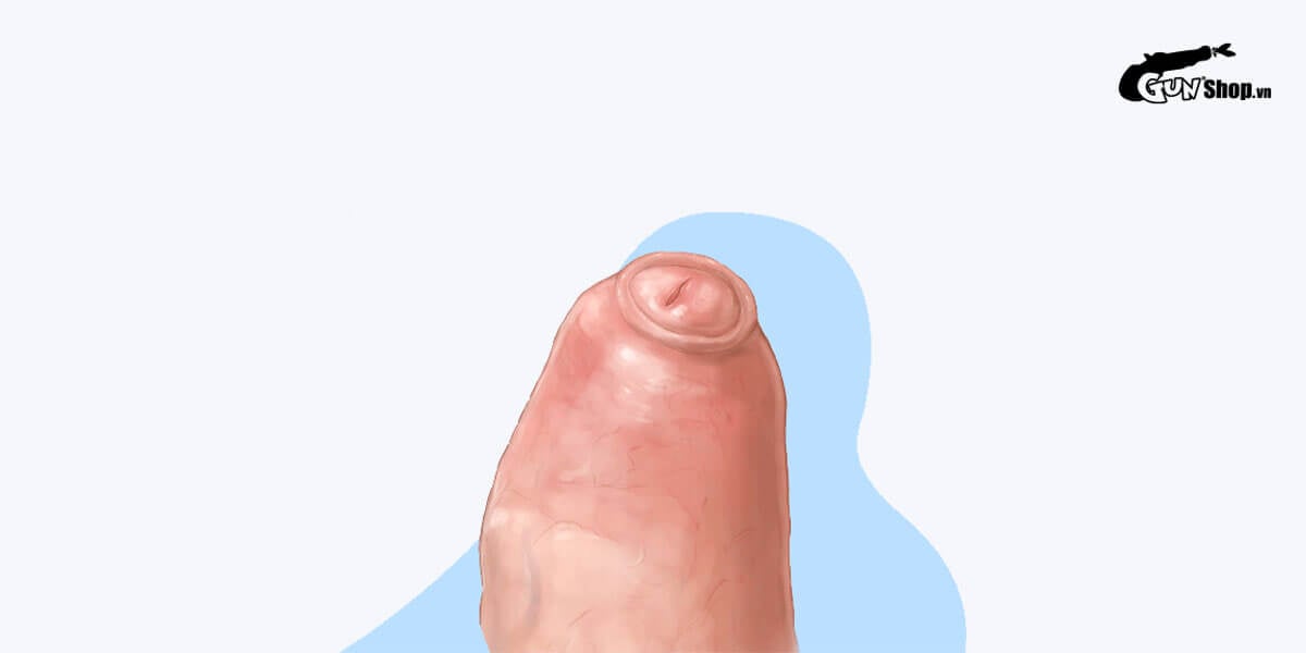 Tắc nghẽn bao quy đầu là gì?